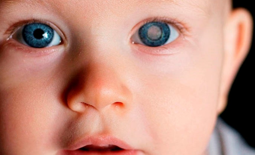 Alto riesgo de glaucoma en bebés con cirugía de cataratas - RoseMaryNEWS
