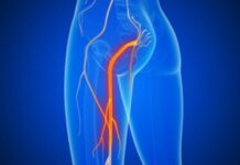 Qué es la ciática: síntomas y medidas naturales para aliviar el dolor
